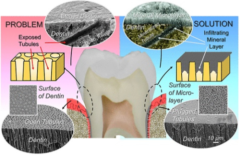 A diagram illustrating how a peptide, derived from the protein used to develop teeth, covers sensitive tissue with new mineral microlayers. 